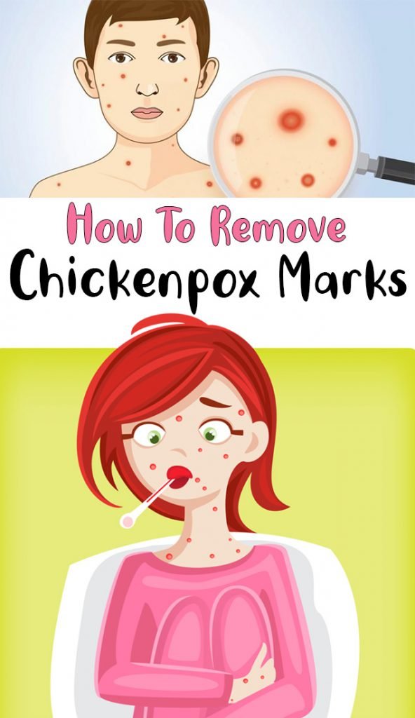 How To Remove Chickenpox Marks Simple Tips for You