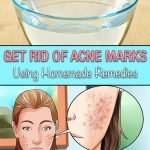 Get Rid of Acne Marks Using Homemade Remedies