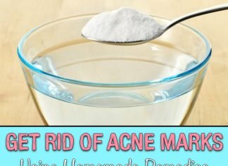 Get Rid of Acne Marks Using Homemade Remedies