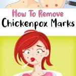 How To Remove Chickenpox Marks