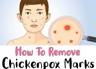 How To Remove Chickenpox Marks